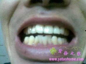 国产牙套会碎吗图片视频,揭秘碎裂真相