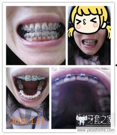 国产牙套会碎吗图片视频,揭秘碎裂真相